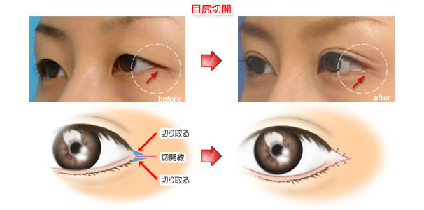 目尻切開