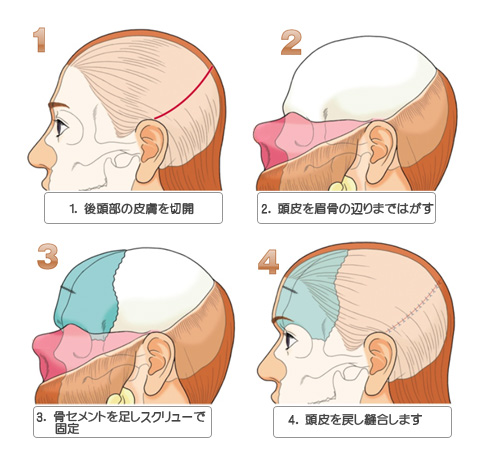 骨セメントというプラスチックで作ったプロテーゼをおでこの骨の上にかぶせる