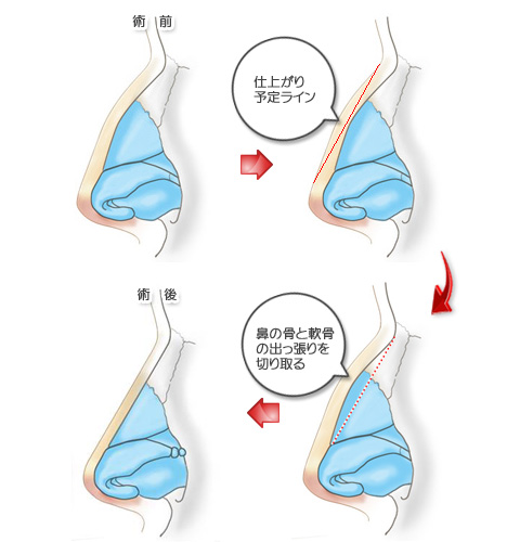 わし鼻修正の流れ