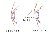 厚みがある二重