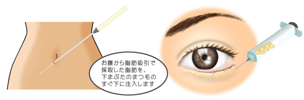 脂肪注入