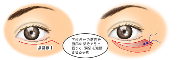 自家組織