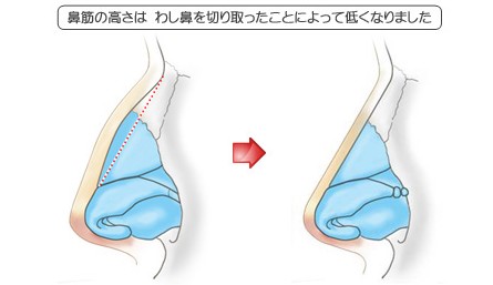 わし鼻修正の症例その1