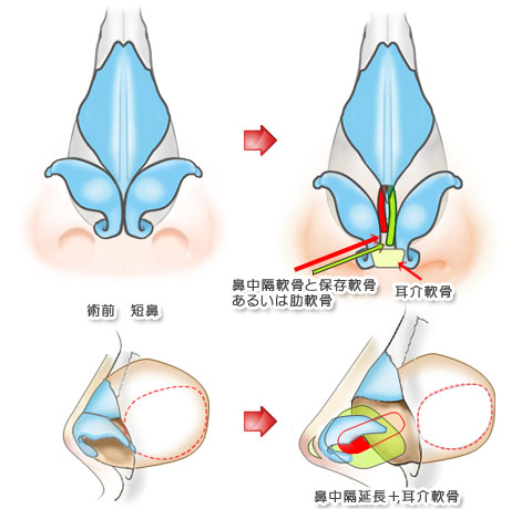 鼻中隔延長術イラスト