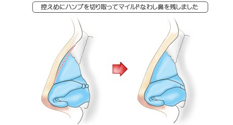 わし鼻修正の症例その1