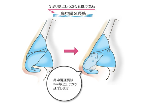 鼻先を３ミリ以上しっかり延ばさなければならない患者さんには鼻中隔延長術