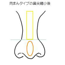 肉まんタイプの鼻尖縮小