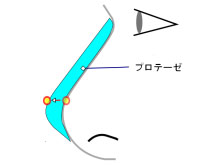 L型のシリコンプロテーゼ