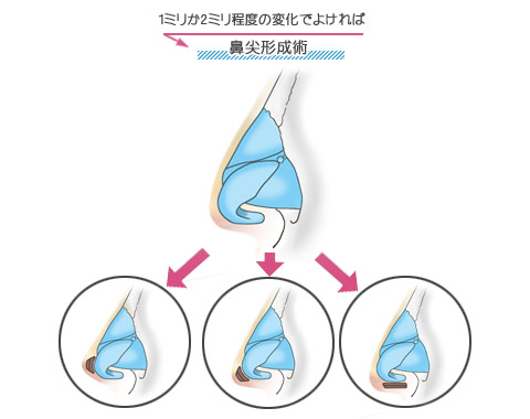 鼻先が1ミリか2ミリ程度高く、あるいは長くなれば十分な方は鼻尖形成術