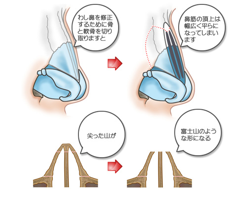 わし鼻を修正するために骨と軟骨を切り取ると、鼻筋の頂上は幅広く平らになる