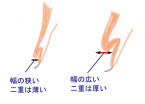 非常にぶ厚い二重