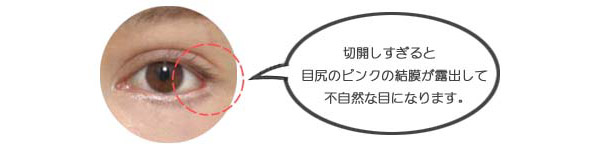 目尻切開