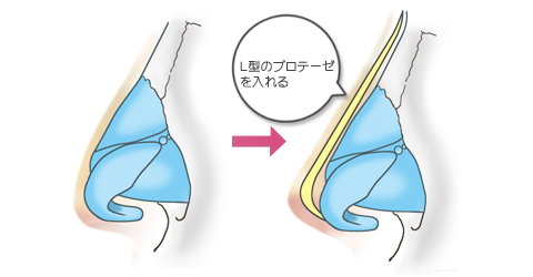 Ｌ型のプロテーゼを入れる