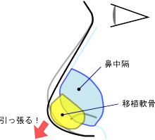 鼻中隔延長