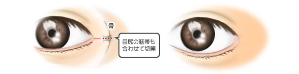 目尻切開