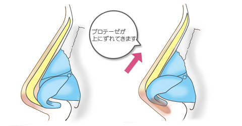 Ｌ型のプロテーゼの問題点は、鼻先の皮膚に押されてプロテーゼが頭側にずれて行きやすい