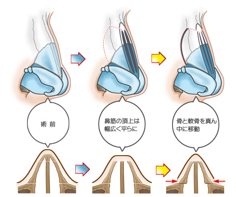 鼻筋の両サイドの骨と軟骨を真ん中に移動