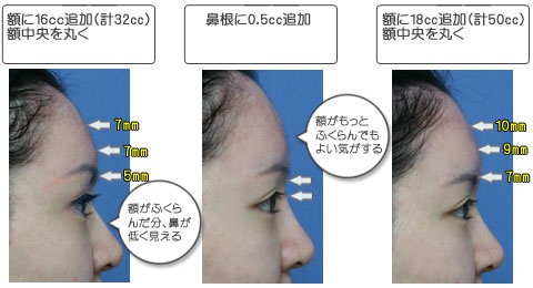 平ら おでこ おでこの膨らみが欲しい！でもお金もないし、、の対処法３選