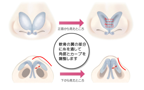 団子鼻の修正の図