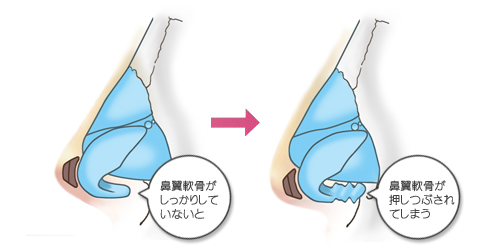 鼻尖軟骨の強度