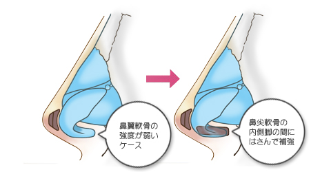 鼻翼軟骨を補強したうえで先端に軟骨を移植