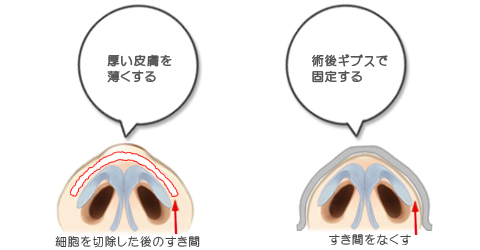 鼻尖の皮フが厚くて硬い人は、皮膚を薄くして軟骨に密着させる