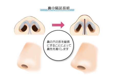 鼻中隔延長術