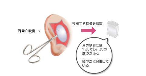 鼻尖形成に使用する軟骨