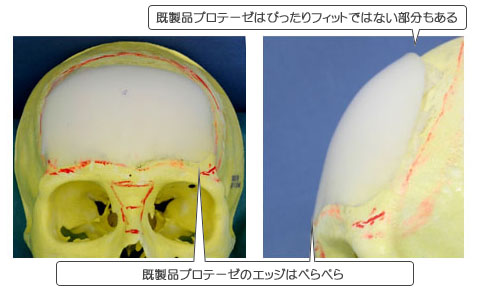 頭骨にシリコンプロテーゼ