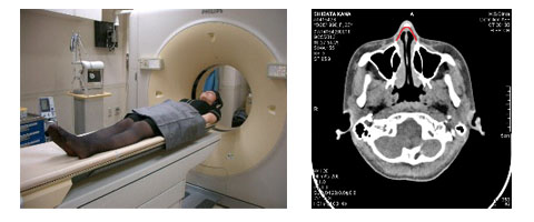 頭のCTを撮影