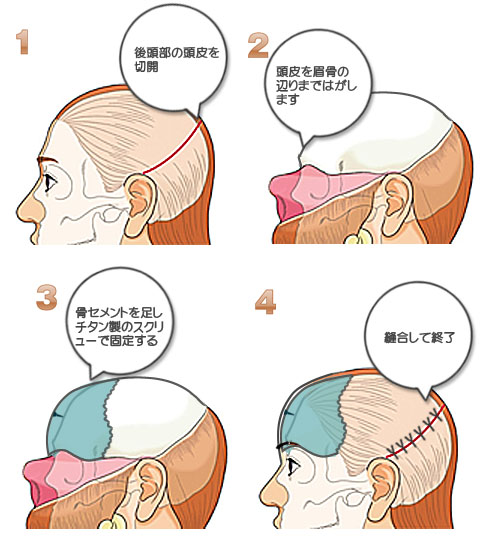 頭骨に骨セメントを挿入の流れ