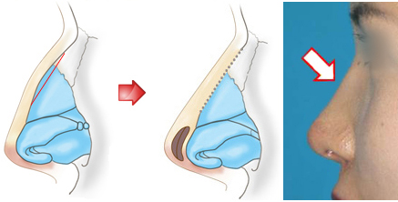 鼻筋の骨と軟骨を少しだけ削る手術と鼻尖形成術を併せて行いました