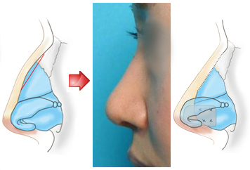 鼻先を高くするために鼻中隔延長術を併せて行いました