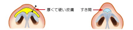  皮膚と軟骨との間に隙間ができて盛り上がる