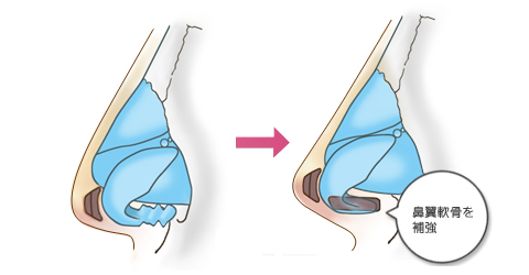 鼻翼軟骨の間に軟骨を挿入して補強します
