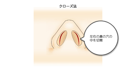 左右の鼻の穴の中を切開