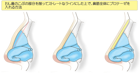 わし鼻のこぶの部分を削ってストレートなラインにした上で、鼻筋全体にプロテーゼを入れる方法