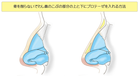 骨を削らないでわし鼻のこぶの部分の上と下にプロテーゼを入れる方法