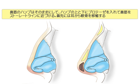 鼻先の高さが物足りない場合2