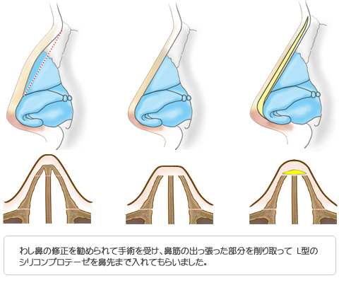 わし鼻の修正を受けたケース