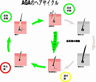 AGAのヘアサイクル