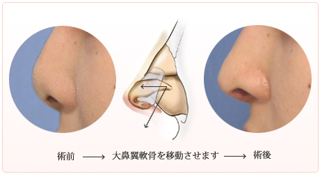 大鼻翼軟骨を下方や前方に移動させる