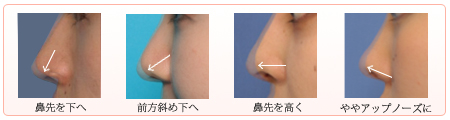 延長方向の基本パターン