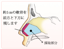 鼻中隔軟骨