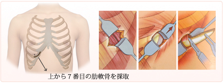 耳珠軟骨