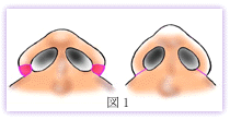 鼻翼縮小　外側切除