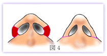 鼻翼縮小　外側切除が行なわれた例