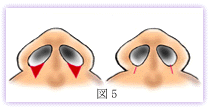 鼻翼縮小　小鼻が外に張り出したタイプに内側切除が行なわれた例