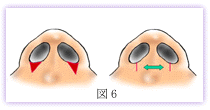 鼻翼縮小　術後に後戻りが起こる例