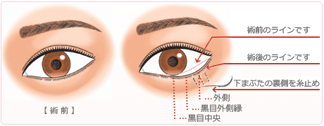 グラマラスライン　下眼瞼下制術